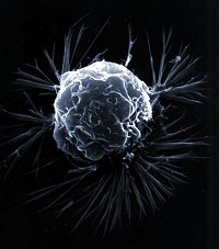 Раковая клетка (иллюстрация с сайта: www.abc.net.au)